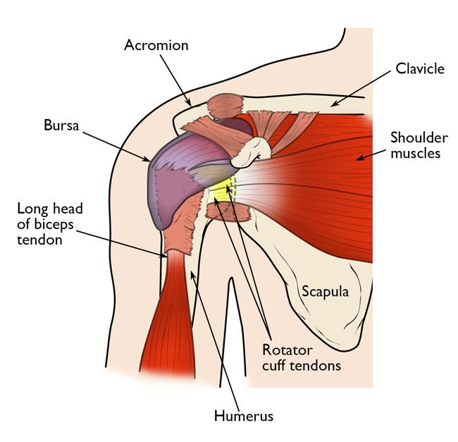 Rotator cuff tear