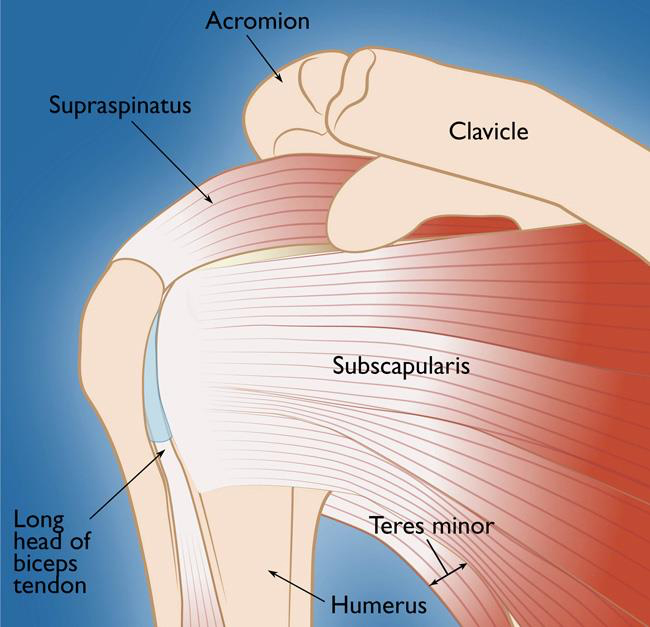 Rotator cuff tear