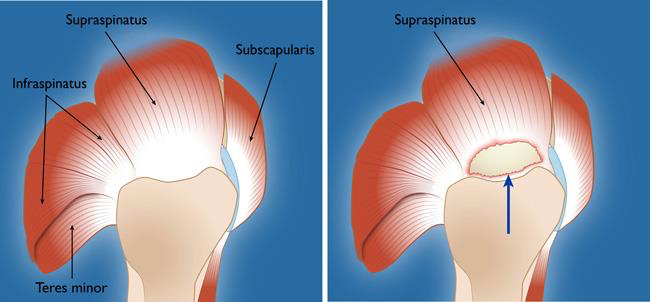 Degenerative Tear