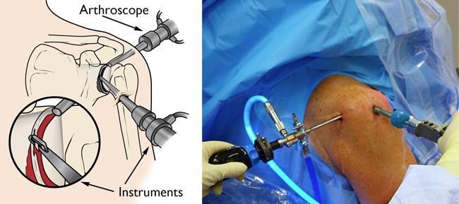 All-Arthroscopic Repair