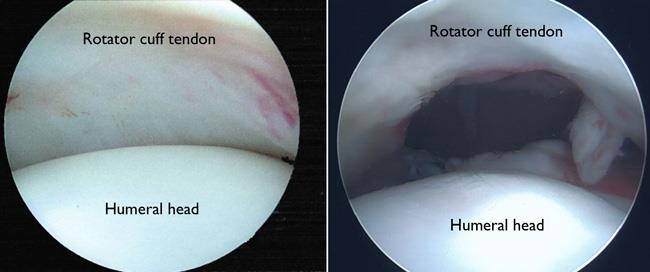 All-Arthroscopic Repair