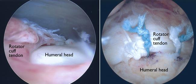 All-Arthroscopic Repair