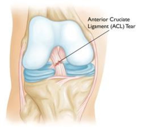 Torn ACL