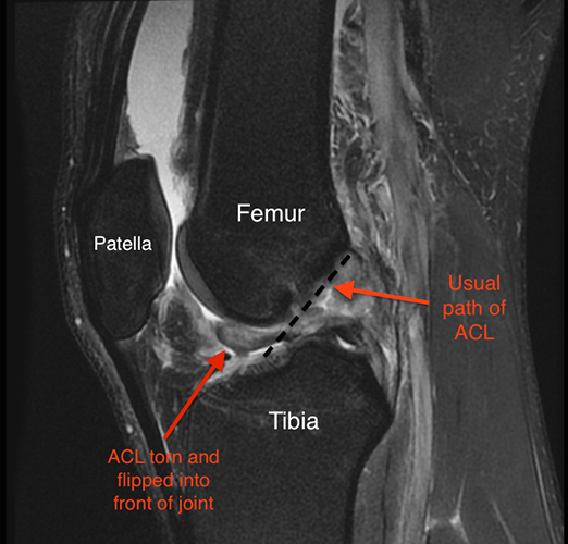 Torn ACL